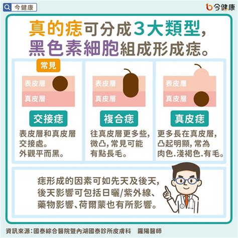 長毛的痣|是痣or皮膚癌？醫「1張圖秒對照」 長這2部位最危險